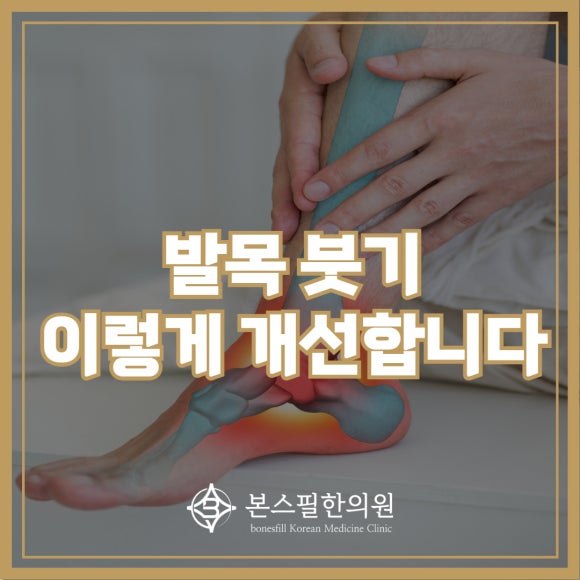 스포츠 활동 중 생긴 발목 붓기로 내원해 주신 30대 남성 분의 사례