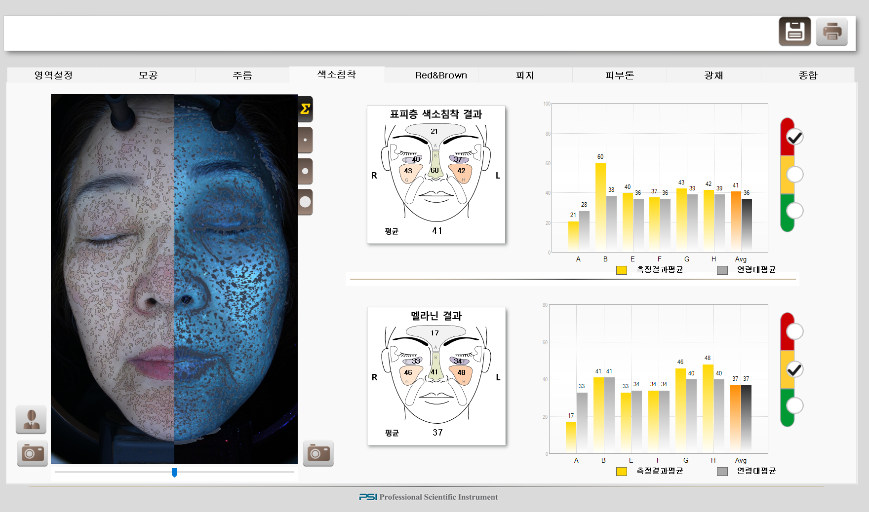 최영옥님 색소 침착 05.02.bmp